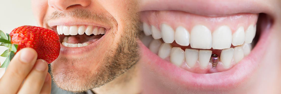 dentista Monza implantologia