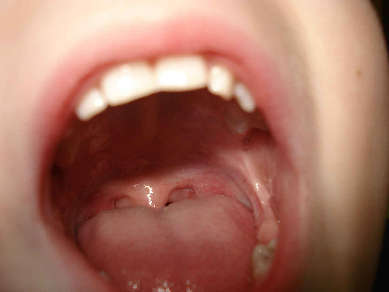 mal di denti ascesso gonfiore