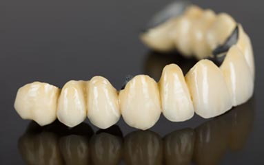 Protesi Fissa in Metallo – ceramica